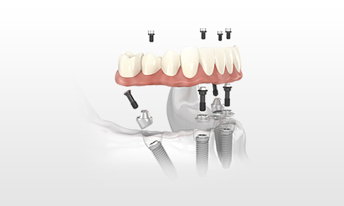 dental implants - Sarasota, FL