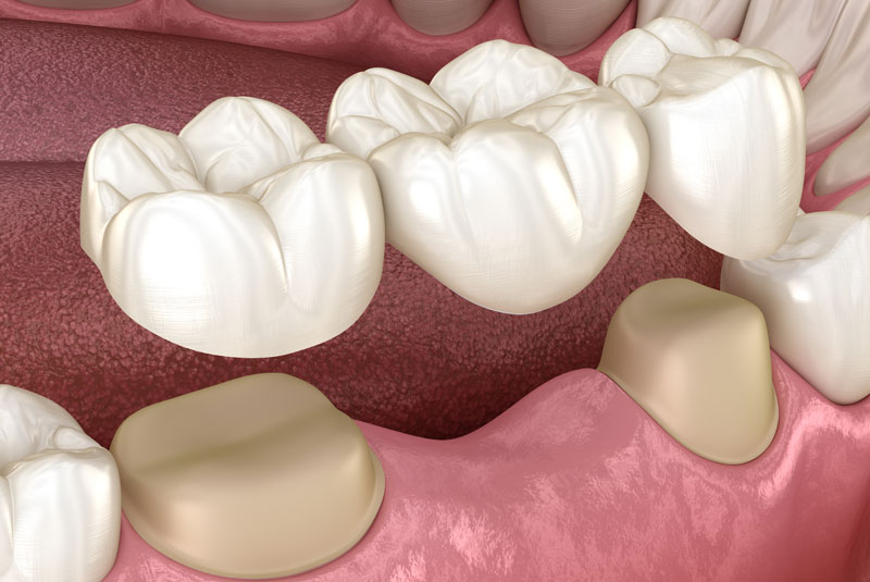 How Your Dental Implants Look In Your Mouth