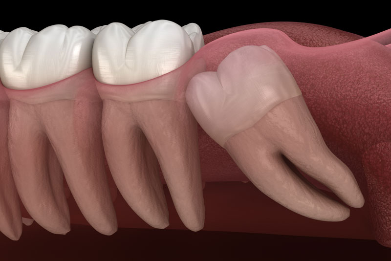 Impacted Wisdom Tooth
