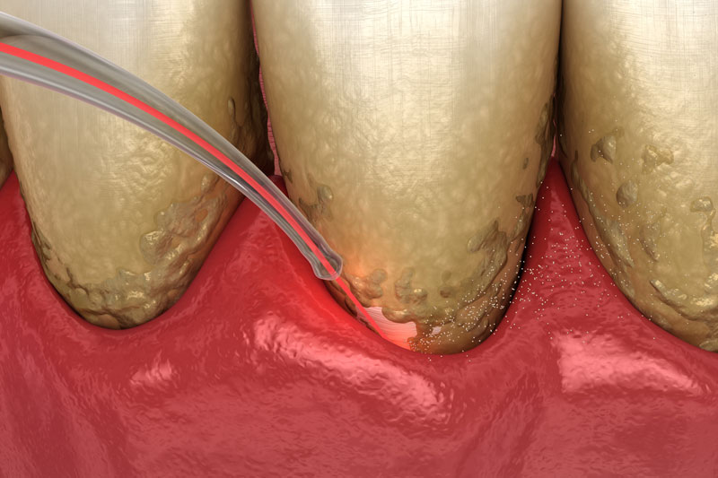 Laser perio treatment that is used to prevent gum disease
