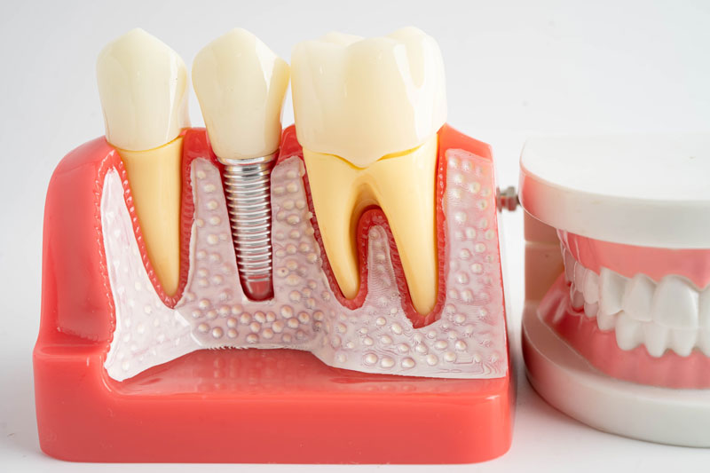 a single dental implant with a full arch of teeth sitting next to it