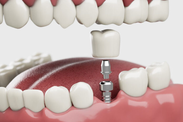 3D illustration of a single dental implant placement, showing the titanium implant post, abutment, and dental crown aligned above the gumline between two natural teeth.