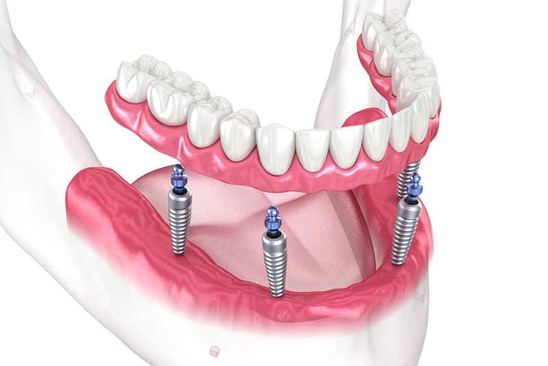 3D illustration of a lower jaw showing a full arch dental prosthesis supported by four dental implants, representing an All-on-4 implant restoration system.