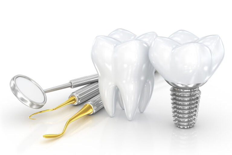 Dental implant screw next to a set of model teeth and dental examination tools (mirror and scalers) on a white background.