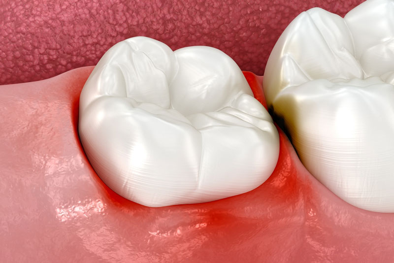 3D illustration of inflamed gums between two molars showing early signs of gum disease and plaque buildup
