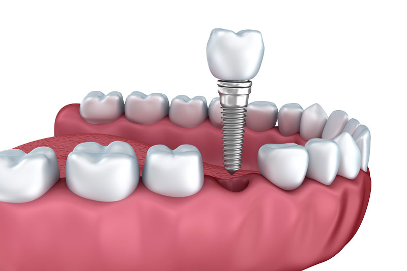 An infographic outlining the "steps of a dental implant" including consultation, imaging, implant placement, healing, abutment, and final crown. No text on the image.