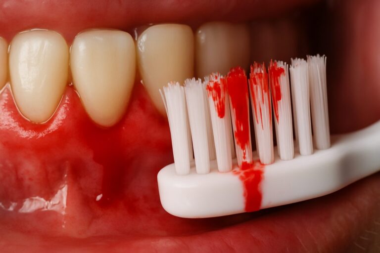 Close-up image of inflamed gums with blood on a toothbrush, emphasizing the need for specialized dental care. No text on image.